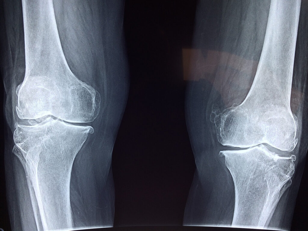 関節痛のある関節のレントゲン写真